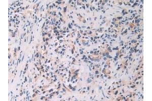 Detection of FBLN1 in Human Prostate cancer Tissue using Polyclonal Antibody to Fibulin 1 (FBLN1) (Fibulin 1 Antikörper  (AA 176-398))