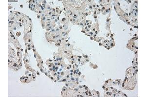 Immunohistochemical staining of paraffin-embedded Adenocarcinoma of breast tissue using anti-NTRK3 mouse monoclonal antibody.