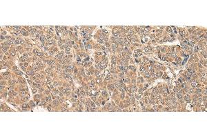 Immunohistochemistry of paraffin-embedded Human liver cancer tissue using RCAN3 Polyclonal Antibody at dilution of 1:60(x200) (RCAN3 Antikörper)