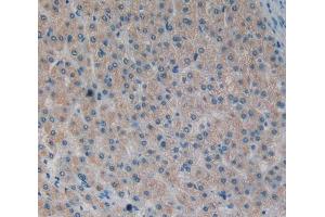 IHC-P analysis of liver cancer tissue, with DAB staining. (MOK Antikörper  (AA 173-418))