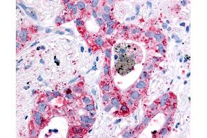 Anti-EGFR antibody IHC of human Lung, Non-Small Cell Carcinoma. (EGFR Antikörper)