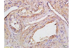 Formalin-fixed and paraffin embedded human cervical carcinoma labeled with Anti-CCDC90A Polyclonal Antibody, Unconjugated  at 1:200 followed by conjugation to the secondary antibody (CCDC90A Antikörper  (AA 261-359))