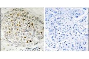 Immunohistochemistry analysis of paraffin-embedded human breast carcinoma tissue, using HDAC5 (Ab-498) Antibody. (HDAC5 Antikörper  (AA 464-513))