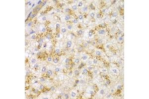 Immunohistochemistry of paraffin-embedded human liver cancer using ACTN1 antibody at dilution of 1:100 (400x lens). (ACTN1 Antikörper)