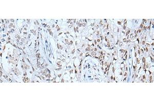 Immunohistochemistry of paraffin-embedded Human lung cancer tissue using BRD3 Polyclonal Antibody at dilution of 1:60(x200) (BRD3 Antikörper)