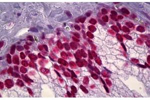 Anti-DNA ds antibody IHC staining of human prostate. (dsDNA Antikörper)