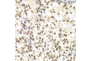 Immunohistochemistry of paraffin-embedded human kidney cancer using UHRF2 antibody (ABIN6133264, ABIN6149911, ABIN6149913 and ABIN6217665) at dilution of 1:200 (40x lens). (UHRF2 Antikörper  (AA 441-622))
