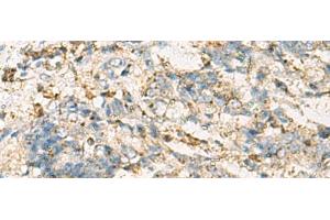 Immunohistochemistry of paraffin-embedded Human cervical cancer tissue using VTA1 Polyclonal Antibody at dilution of 1:60(x200)