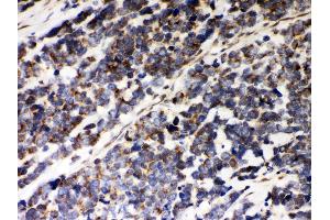 Anti- Peroxiredoxin 5 Picoband antibody, IHC(P) IHC(P): Human Lung Cancer Tissue (Peroxiredoxin 5 Antikörper  (AA 66-198))
