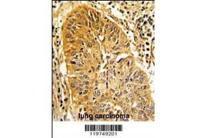 Formalin-fixed and paraffin-embedded human lung carcinoma with CALD1 Antibody , which was peroxidase-conjugated to the secondary antibody, followed by DAB staining. (Caldesmon Antikörper  (AA 428-457))