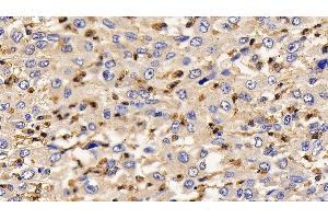 Detection of IL13Ra2 in Human Liver cancer Tissue using Polyclonal Antibody to Interleukin 13 Receptor Alpha 2 (IL13Ra2) (IL13RA2 Antikörper  (AA 238-334))