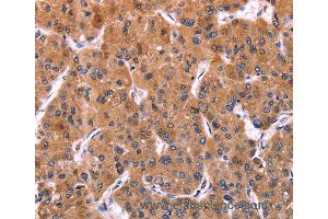 Immunohistochemistry of Human liver cancer using ERP29 Polyclonal Antibody at dilution of 1:40 (ERP29 Antikörper)