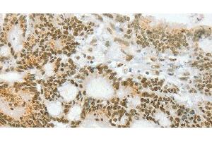 Immunohistochemistry of paraffin-embedded Human colon cancer using ANGPT4 Polyclonal Antibody at dilution of 1:70 (Angiopoietin 4 Antikörper)