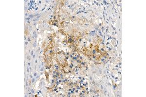 Immunohistochemistry of paraffin-embedded human esophageal cancer using CNTN4 Rabbit mAb (ABIN7266495) at dilution of 1:100 (40x lens). (Contactin 4 Antikörper)