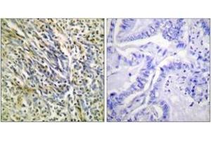 Immunohistochemistry analysis of paraffin-embedded human lung carcinoma tissue, using Aggrecan (Cleaved-Asp369) Antibody. (Aggrecan Antikörper  (Cleaved-Asp369))