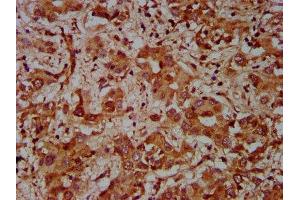 IHC image of ABIN7148760 diluted at 1:600 and staining in paraffin-embedded human liver cancer performed on a Leica BondTM system. (Cullin 7 Antikörper  (AA 312-450))