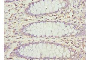 Immunohistochemistry of paraffin-embedded human colon cancer using ABIN7162995 at dilution of 1:100 (PECR Antikörper  (AA 24-303))