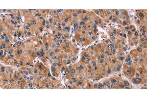 Immunohistochemistry of paraffin-embedded Human liver cancer tissue using LILRB1 Polyclonal Antibody at dilution 1:50 (LILRB1 Antikörper)