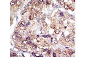 IHC analysis of FFPE human hepatocarcinoma tissue stained with the LYN antibody