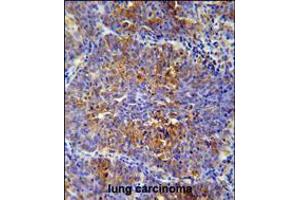 MCAF2 Antibody immunohistochemistry analysis in formalin fixed and paraffin embedded human lung carcinoma followed by peroxidase conjugation of the secondary antibody and DAB staining. (ATF7IP2 Antikörper  (AA 318-347))