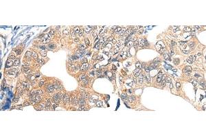 Immunohistochemistry of paraffin-embedded Human gastric cancer tissue using EPHA6 Polyclonal Antibody at dilution of 1:40(x200) (EPH Receptor A6 Antikörper)