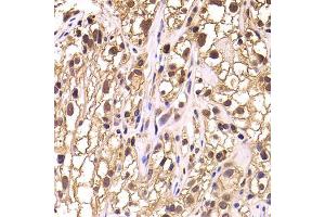 Immunohistochemistry of paraffin-embedded human kidney cancer using TCEB3 antibody (ABIN5975459) at dilution of 1/100 (40x lens). (TCEB3 Antikörper)