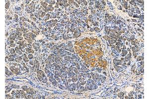 ABIN6261372 and ABIN6279351 at 1/100 staining Human pancreatic cancer and adjacent nomal tissues by IHC-P. (Desmoglein 3 Antikörper  (C-Term))
