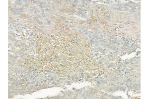 ABIN6260235 and ABIN6276561 at 1/100 staining human lung squamous cell carcinoma by IHC-P. (BCL2L2 Antikörper  (N-Term))