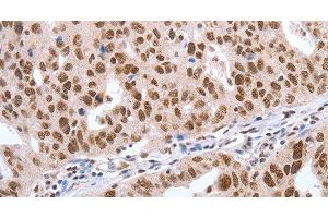 Immunohistochemistry of paraffin-embedded Human ovarian cancer tissue using Oct-6 Polyclonal Antibody at dilution 1:40
