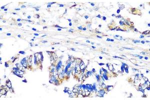 Immunohistochemistry of paraffin-embedded Human colon carcinoma using PBEF / NAMPT Polyclonal Antibody at dilution of 1:100 (40x lens). (NAMPT Antikörper)