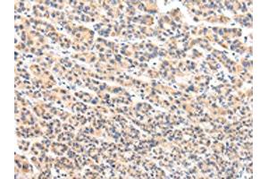 The image on the left is immunohistochemistry of paraffin-embedded Human liver cancer tissue using ABIN7131592(VPS54 Antibody) at dilution 1/20, on the right is treated with fusion protein. (VPS54 Antikörper)