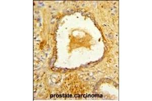 Immunohistochemistry (Paraffin-embedded Sections) (IHC (p)) image for anti-Disabled Homolog 2, Mitogen-Responsive phosphoprotein (Drosophila) (DAB2) (AA 743-770), (C-Term) antibody (ABIN652936)