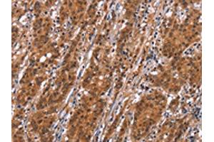 The image on the left is immunohistochemistry of paraffin-embedded Human gastric cancer tissue using ABIN7192526(SLC8A2 Antibody) at dilution 1/15, on the right is treated with synthetic peptide. (SLC8A2 Antikörper)