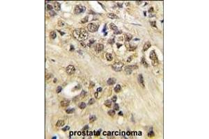 Formalin-fixed and paraffin-embedded human prostata carcinoma tissue reacted with MYC Antibody (T58) (ABIN388723 and ABIN2838831) , which was peroxidase-conjugated to the secondary antibody, followed by DAB staining.