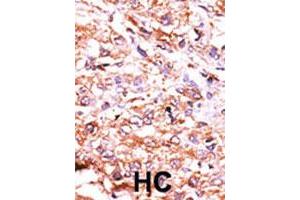 Formalin-fixed and paraffin-embedded human hepatocellular carcinoma tissue reacted with GUCY1A2 polyclonal antibody  , which was peroxidase-conjugated to the secondary antibody, followed by AEC staining. (GUCY1A2 Antikörper  (N-Term))
