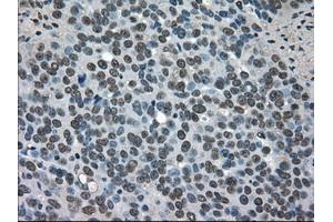 Immunohistochemical staining of paraffin-embedded Adenocarcinoma of breast tissue using anti-SOD1 mouse monoclonal antibody. (SOD1 Antikörper)