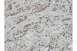 IHC-P Image Immunohistochemical analysis of paraffin-embedded oral CA cell lines Ca922 xenograft, using BCL7A, antibody at 1:100 dilution. (BCL7A Antikörper  (C-Term))