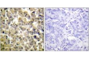 Immunohistochemistry analysis of paraffin-embedded human breast carcinoma, using MSK1 (Phospho-Ser360) Antibody.