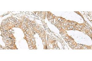 Immunohistochemistry of paraffin-embedded Human colorectal cancer tissue using SLC5A1 Polyclonal Antibody at dilution of 1:80(x200) (SLC5A1 Antikörper)