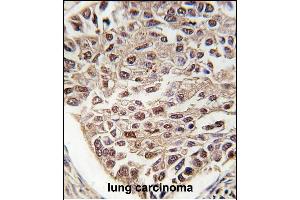 Formalin-fixed and paraffin-embedded human lung carcinoma tissue reacted with SFRS2 antibody (N-term), which was peroxidase-conjugated to the secondary antibody, followed by DAB staining. (SRSF2 Antikörper  (N-Term))