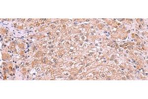 Immunohistochemistry of paraffin-embedded Human liver cancer tissue using RIC3 Polyclonal Antibody at dilution of 1:90(x200) (RIC3 Antikörper)