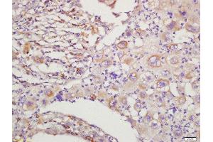 Formalin-fixed and paraffin embedded human lung cancer labeled with Rabbit Anti-RAC1+RAC2 Polyclonal Antibody, Unconjugated  at 1:200 followed by conjugation to the secondary antibody and DAB staining (RAC1 Antikörper  (AA 101-192))