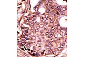 Formalin-fixed and paraffin-embedded human cancer tissue (breast carcinoma) reacted with the primary antibody, which was peroxidase-conjugated to the secondary antibody, followed by DAB staining. (SEPHS2 Antikörper  (Middle Region))