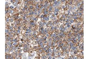 ABIN6266637 at 1/100 staining human lung carcinoma tissue sections by IHC-P.