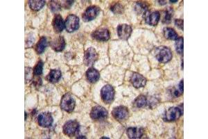 IHC analysis of FFPE human prostate carcinoma tissue stained with PDGFR alpha antibody (PDGFRA Antikörper  (AA 740-769))