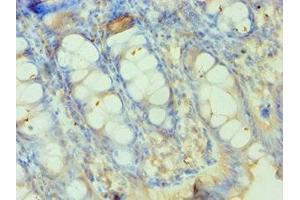 Immunohistochemistry of paraffin-embedded human colon tissue using ABIN7155524 at dilution of 1:100 (SMYD3 Antikörper  (AA 199-428))