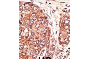 Formalin-fixed and paraffin-embedded human cancer tissue reacted with the primary antibody, which was peroxidase-conjugated to the secondary antibody, followed by AEC staining. (Septin 9 Antikörper  (C-Term))