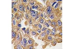 IHC analysis of FFPE human lung carcinoma tissue stained with AKT2 antibody (AKT2 Antikörper  (AA 452-481))