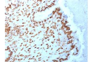 Formalin-fixed, paraffin-embedded human Endometrial Carcinoma stained with TLE1 Mouse Monoclonal Antibody (TLE1/2062). (TLE1 Antikörper  (AA 175-338))