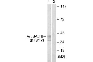 Immunohistochemistry analysis of paraffin-embedded human liver carcinoma tissue using AurB (Phospho-Tyr12) antibody. (Aurora Kinase B Antikörper  (pTyr12))